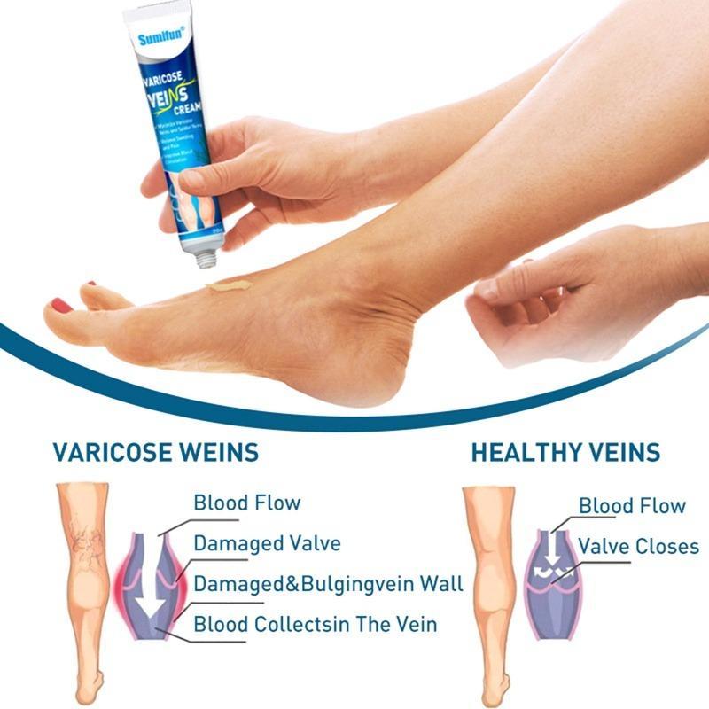 FreeShipping『BUY 2 TAKE 1』Varicose Veins Cream Soothing Leg Cream Natural Herbal Plaster for Tired and Heavy Legs Fast Relief Strengthen Capillary Health Improve Blood Circulation